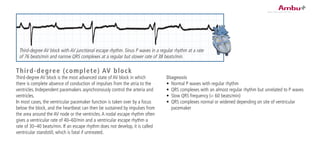 Diagnosis
•	 Normal P waves with regular rhythm
•	 QRS complexes with an almost regular rhythm but unrelated to P waves
•	 Slow QRS frequency (< 60 beats/min)
•	 QRS complexes normal or widened depending on site of ventricular
pacemaker
Third-degree (complete) AV block
Third-degree AV block is the most advanced state of AV block in which
there is complete absence of conduction of impulses from the atria to the
ventricles. Independent pacemakers asynchronously control the arteria and
ventricles.
In most cases, the ventricular pacemaker function is taken over by a focus
below the block, and the heartbeat can then be sustained by impulses from
the area around the AV node or the ventricles.A nodal escape rhythm often
gives a ventricular rate of 40–60/min and a ventricular escape rhythm a
rate of 30–40 beats/min. If an escape rhythm does not develop, it is called
ventricular standstill, which is fatal if untreated.
Third-degree AV block with AV junctional escape rhythm. Sinus P waves in a regular rhythm at a rate
of 76 beats/min and narrow QRS complexes at a regular but slower rate of 38 beats/min.
 