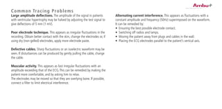 Alternating current interference. This appears as fluctuations with a
constant amplitude and frequency (50Hz) superimposed on the waveform.
It can be remedied by:
•	 Ensuring the best possible electrode contact.
•	 Switching off radios and lamps.
•	 Moving the patient away from plugs and cables in the wall.
•	 Placing the ECG electrodes parallel to the patient’s vertical axis.
Common Tracing Problems
Large amplitude deflections. The amplitude of the signal in patients
with ventricular hypertrophy may be halved by adjusting the test signal to
give deflections of 5 mm (1 mV).
Poor electrode technique. This appears as irregular fluctuations in the
recording. Obtain better contact with the skin, change the electrodes or, if
using dry (non-gelled) electrodes, apply more electrode paste.
Defective cables. Sharp fluctuations or an isoelectric waveform may be
seen. If disturbances can be produced by gently pulling the cable, change
the cable.
Muscular activity. This appears as fast irregular fluctuations with an
amplitude exceeding that of the ECG.This can be remedied by making the
patient more comfortable, and by asking him to relax.
The electrodes may be moved so that they are overlying bone. If possible,
connect a filter to limit electrical interference.
 