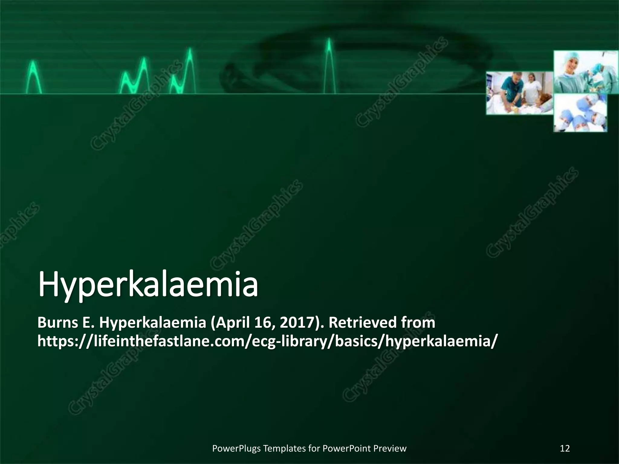 Hyperkalaemia
Burns E. Hyperkalaemia (April 16, 2017). Retrieved from
https://lifeinthefastlane.com/ecg-library/basics/hyperkalaemia/
PowerPlugs Templates for PowerPoint Preview 12
 