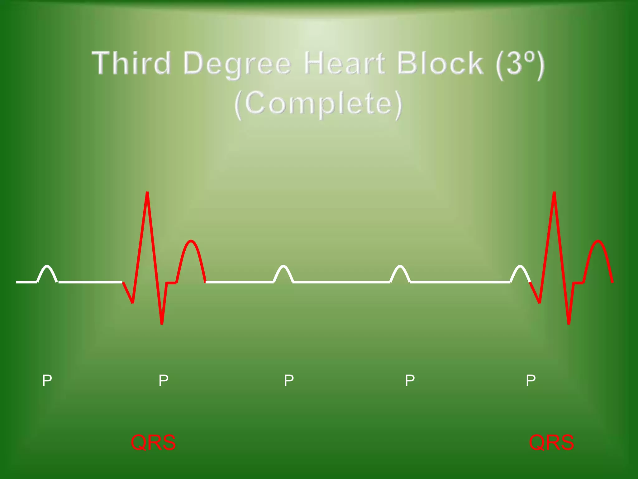 P

P

QRS

P

P

P

QRS

 