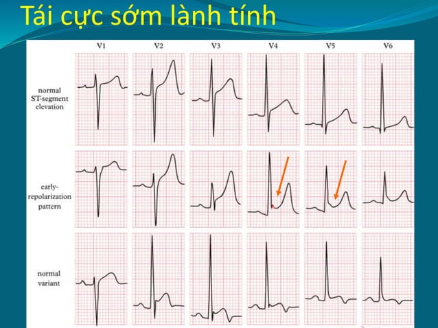 ECG hội chứng vành cấp - 2.pptx