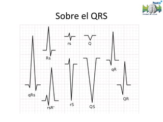 Sobre el QRS
 