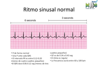 Ritmo sinusal normal
 