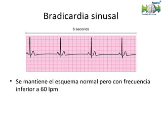 Bradicardia sinusal




• Se mantiene el esquema normal pero con frecuencia
  inferior a 60 lpm
 