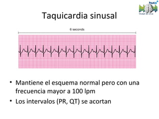 Taquicardia sinusal




• Mantiene el esquema normal pero con una
  frecuencia mayor a 100 lpm
• Los intervalos (PR, QT) se acortan
 