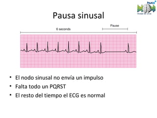 Pausa sinusal




• El nodo sinusal no envía un impulso
• Falta todo un PQRST
• El resto del tiempo el ECG es normal
 