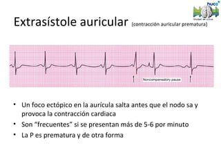 Extrasístole auricular (contracción auricular prematura)




• Un foco ectópico en la aurícula salta antes que el nodo sa y
  provoca la contracción cardiaca
• Son “frecuentes” si se presentan más de 5-6 por minuto
• La P es prematura y de otra forma
 
