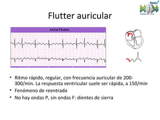 Flutter auricular




• Ritmo rápido, regular, con frecuencia auricular de 200-
  300/min. La respuesta ventricular suele ser rápida, a 150/min
• Fenómeno de reentrada
• No hay ondas P, sin ondas F: dientes de sierra
 