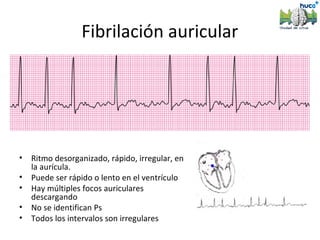 Fibrilación auricular




•   Ritmo desorganizado, rápido, irregular, en
    la aurícula.
•   Puede ser rápido o lento en el ventrículo
•   Hay múltiples focos auriculares
    descargando
•   No se identifican Ps
•   Todos los intervalos son irregulares
 