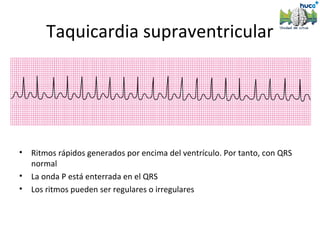Taquicardia supraventricular




•   Ritmos rápidos generados por encima del ventrículo. Por tanto, con QRS
    normal
•   La onda P está enterrada en el QRS
•   Los ritmos pueden ser regulares o irregulares
 