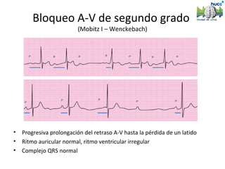 Bloqueo A-V de segundo grado
                          (Mobitz I – Wenckebach)




•   Progresiva prolongación del retraso A-V hasta la pérdida de un latido
•   Ritmo auricular normal, ritmo ventricular irregular
•   Complejo QRS normal
 