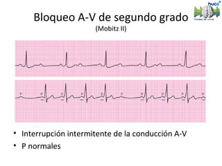 Bloqueo A-V de segundo grado
                      (Mobitz II)




• Interrupción intermitente de la conducción A-V
• P normales
 