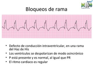 Bloqueos de rama




• Defecto de conducción intraventricular, en una rama
  del Haz de His
• Los ventrículos se despolarizan de modo asincrónico
• P está presente y es normal, al igual que PR
• El ritmo cardiaco es regular
 