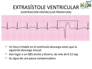 EXTRASÍSTOLE VENTRICULAR
            (CONTRACCIÓN VENTRICULAR PREMATURA)




• Un foco irritable en el ventrículo descarga antes que la
  siguiente descarga sinusal
• Dan lugar a un QRS ancho y bizarro, de más de 0.12 seg
• Se sigue de una pausa compensadora
 