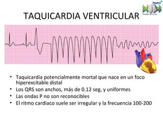 TAQUICARDIA VENTRICULAR




• Taquicardia potencialmente mortal que nace en un foco
  hiperexcitable distal
• Los QRS son anchos, más de 0.12 seg, y uniformes
• Las ondas P no son reconocibles
• El ritmo cardiaco suele ser irregular y la frecuencia 100-200
 