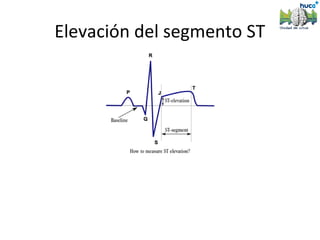 Elevación del segmento ST
 