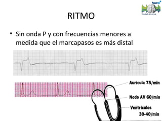 RITMO
• Sin onda P y con frecuencias menores a
  medida que el marcapasos es más distal
 