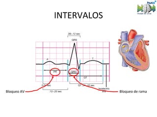 INTERVALOS




Bloqueo AV                Bloqueo de rama
 