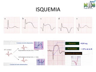 ISQUEMIA
 