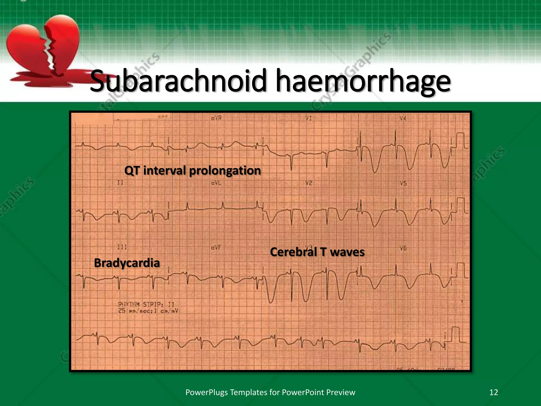 Subarachnoid haemorrhage
PowerPlugs Templates for PowerPoint Preview 12
Cerebral T waves
QT interval prolongation
Bradycardia
 