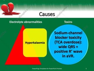 Causes
Electrolyte abnormalities
Hyperkalaemia
Toxins
Sodium-channel
blocker toxicity
(TCA overdose):
wide QRS +
positive R’ wave
in aVR.
PowerPlugs Templates for PowerPoint Preview 5
 