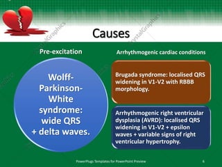 Causes
Pre-excitation
Wolff-
Parkinson-
White
syndrome:
wide QRS
+ delta waves.
Arrhythmogenic cardiac conditions
Brugada syndrome: localised QRS
widening in V1-V2 with RBBB
morphology.
Arrhythmogenic right ventricular
dysplasia (AVRD): localised QRS
widening in V1-V2 + epsilon
waves + variable signs of right
ventricular hypertrophy.
PowerPlugs Templates for PowerPoint Preview 6
 