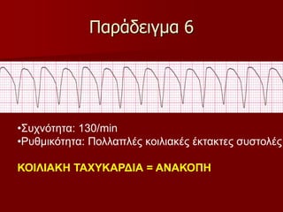 Παράδειγμα 6
•Συχνότητα: 130/min
•Ρυθμικότητα: Πολλαπλές κοιλιακές έκτακτες συστολές
ΚΟΙΛΙΑΚΗ ΤΑΧΥΚΑΡΔΙΑ = ΑΝΑΚΟΠΗ
 