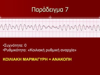 Παράδειγμα 7
•Συχνότητα: 0
•Ρυθμικότητα: «Κοιλιακή ρυθμική αναρχία»
ΚΟΙΛΙΑΚΗ ΜΑΡΜΑΓΥΡΗ = ΑΝΑΚΟΠΗ
 