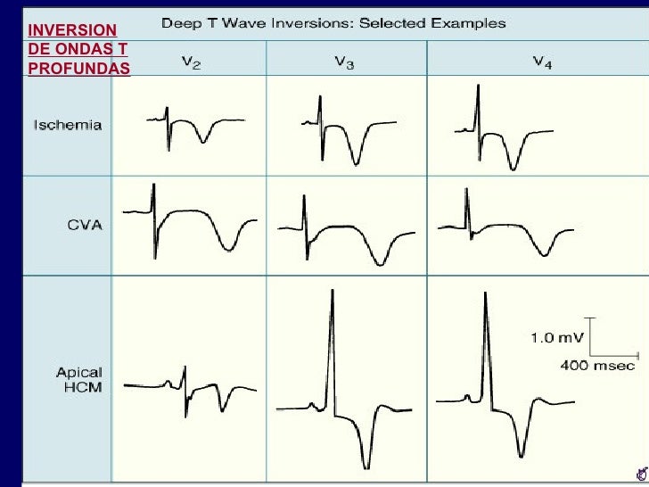 Ecg Ii Isquemia Ecg Ii Isquemia
