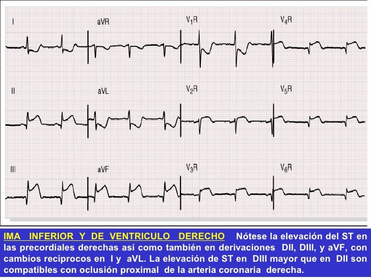 Resultado de imagen para infarto del ventriculo derecho electrocardiograma
