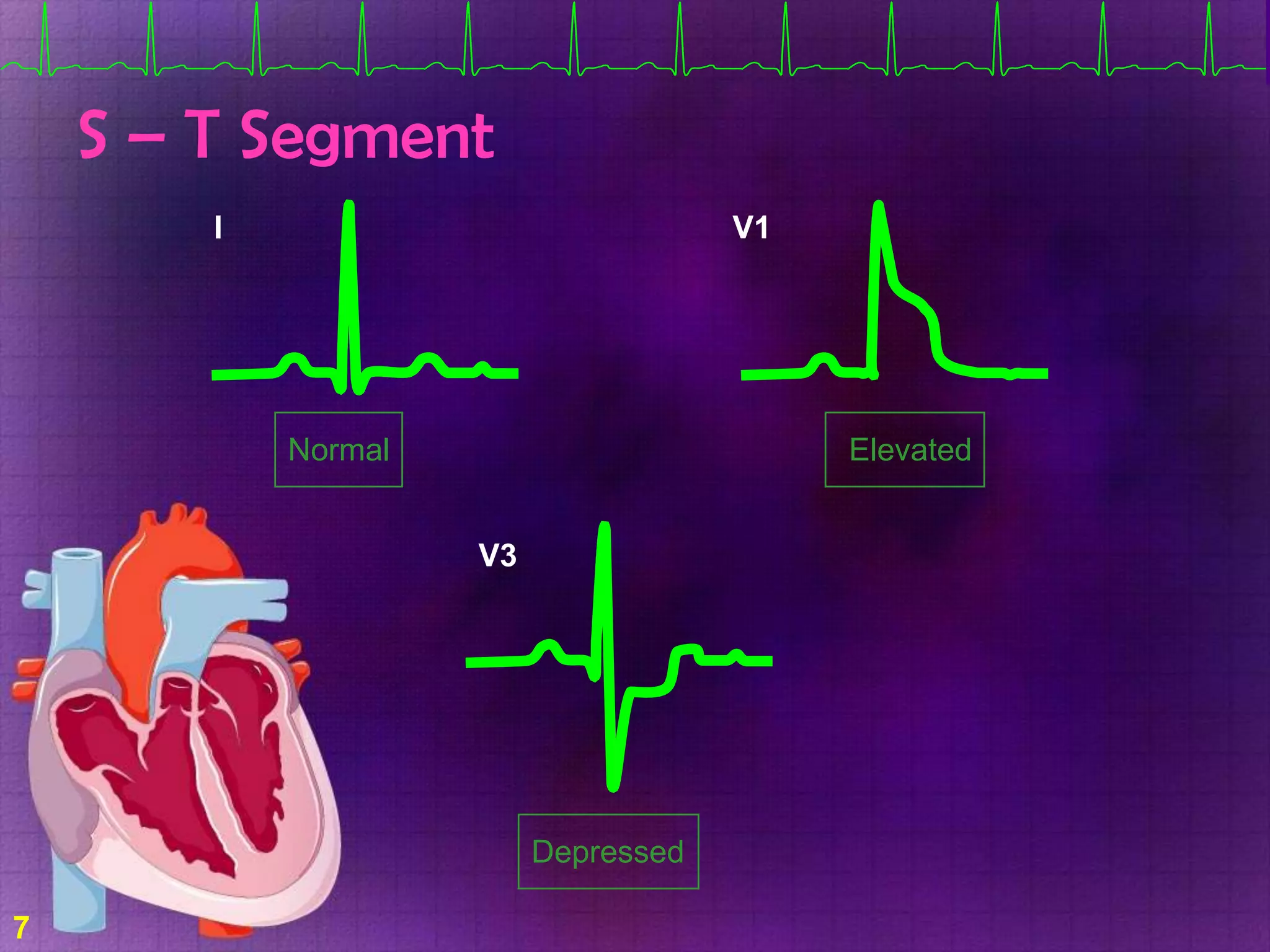 S – T Segment
I

V1

Normal

Elevated
V3

Depressed
7

 