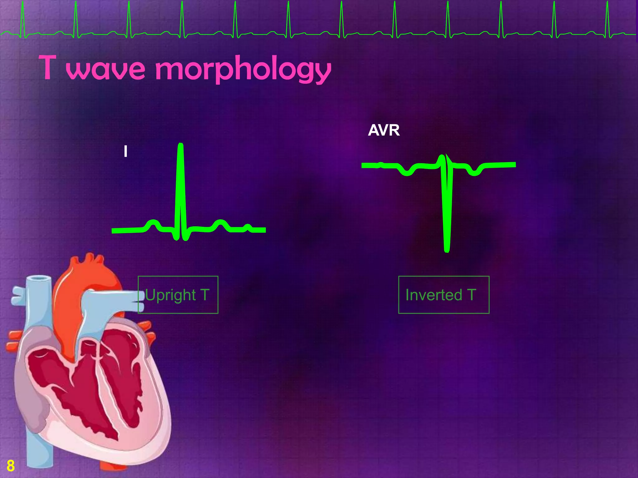 T wave morphology
AVR
I

Upright T

8

Inverted T

 