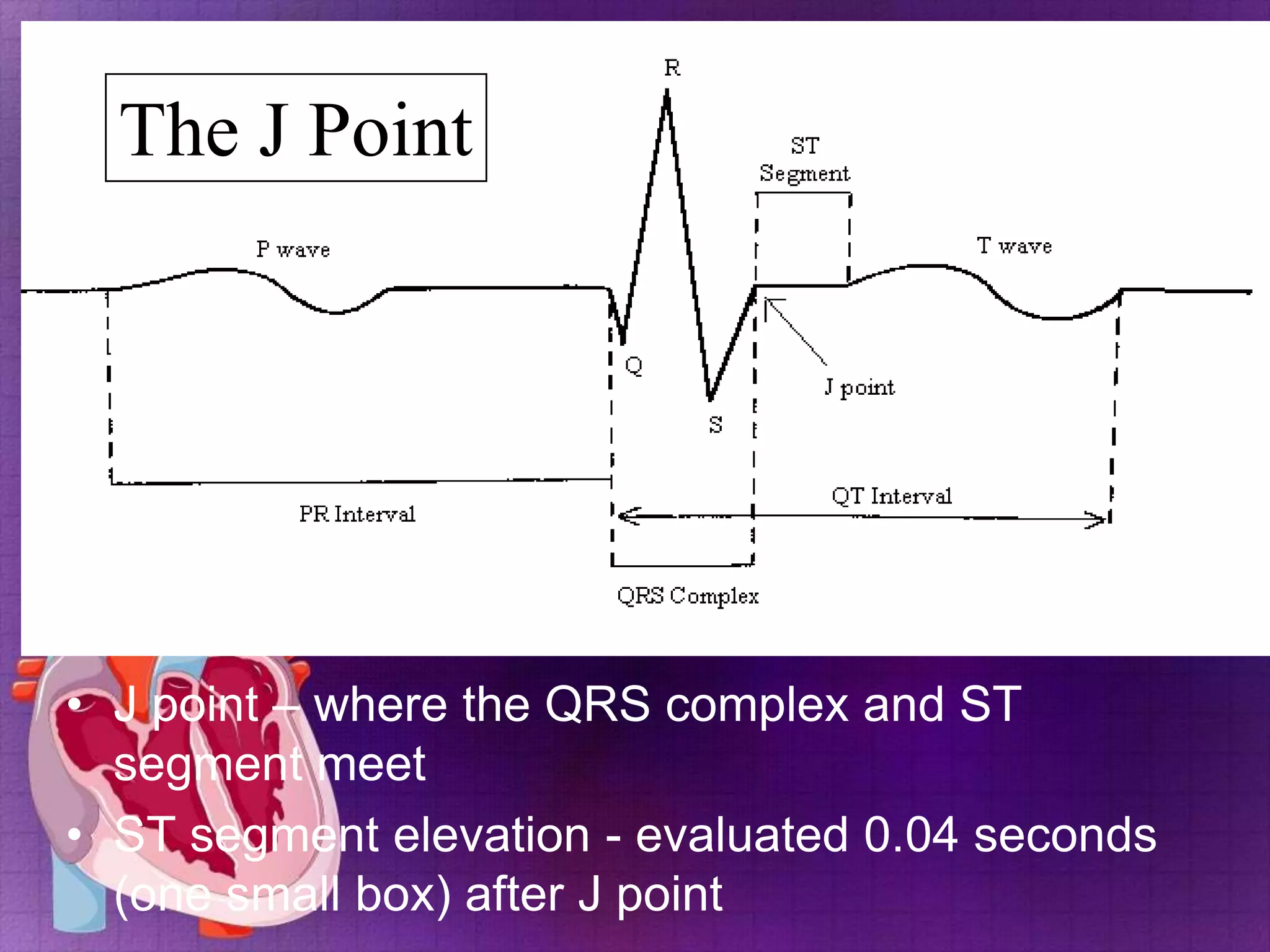 The J Point

• J point – where the QRS complex and ST
segment meet
• ST segment elevation - evaluated 0.04 seconds
(one small box) after J point

 