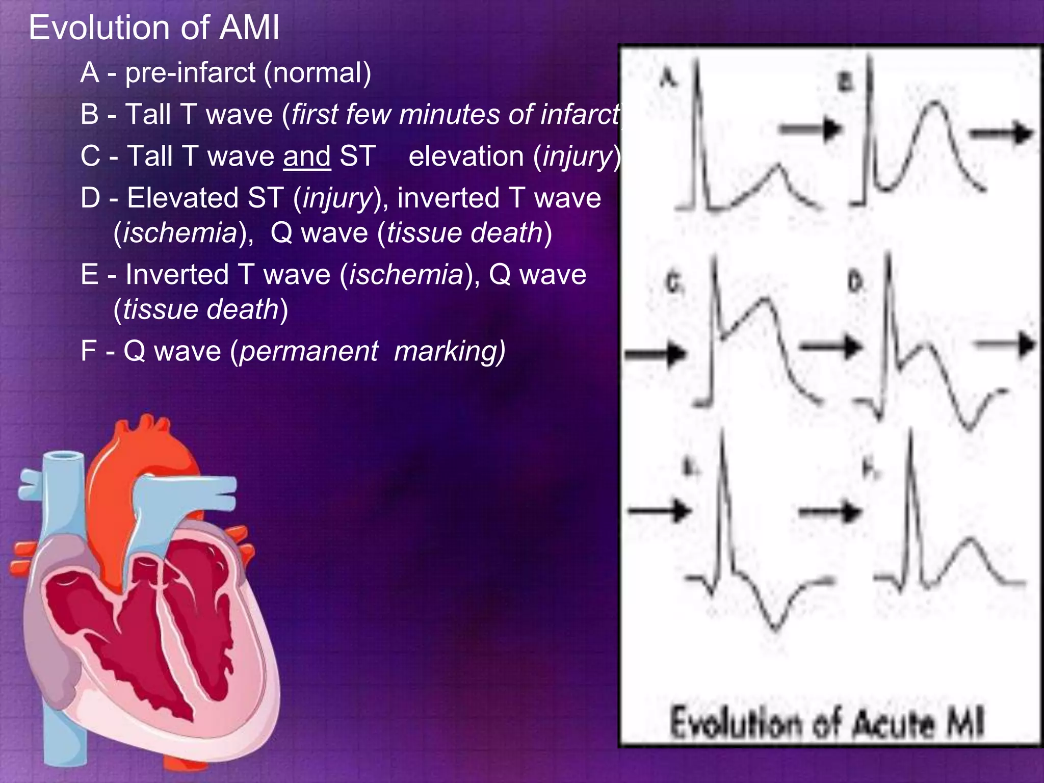Evolution of AMI
A - pre-infarct (normal)
B - Tall T wave (first few minutes of infarct)
C - Tall T wave and ST elevation (injury)
D - Elevated ST (injury), inverted T wave
(ischemia), Q wave (tissue death)
E - Inverted T wave (ischemia), Q wave
(tissue death)
F - Q wave (permanent marking)

 