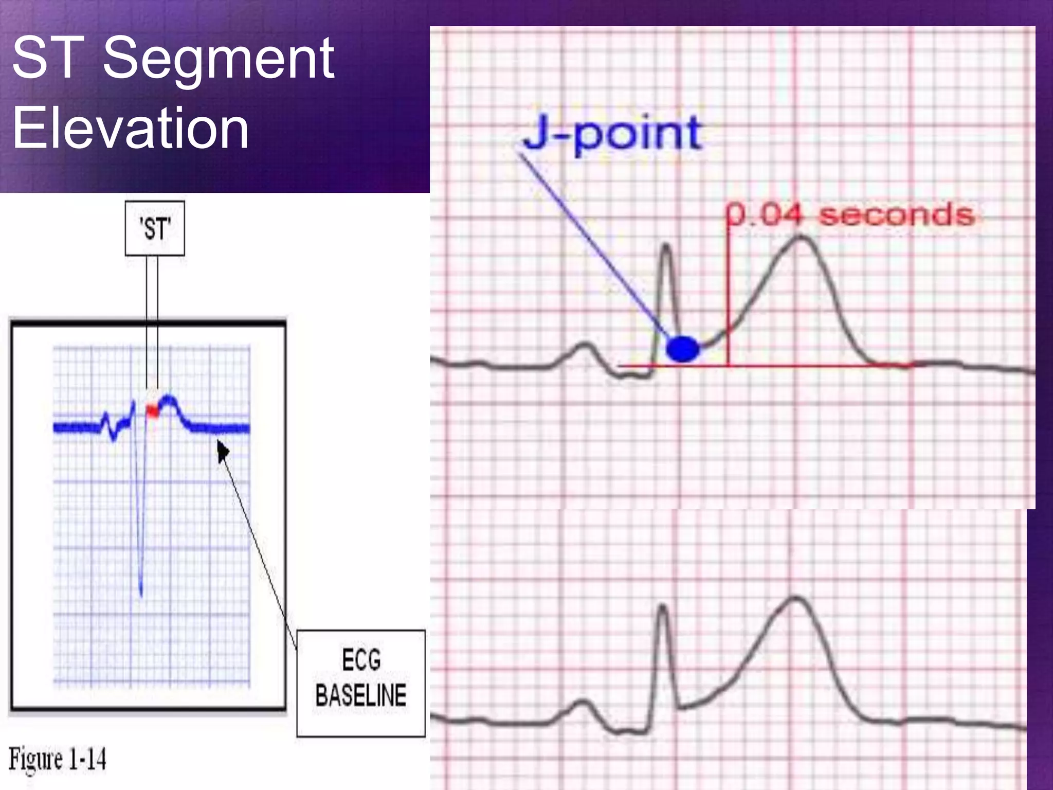 ST Segment
Elevation

 
