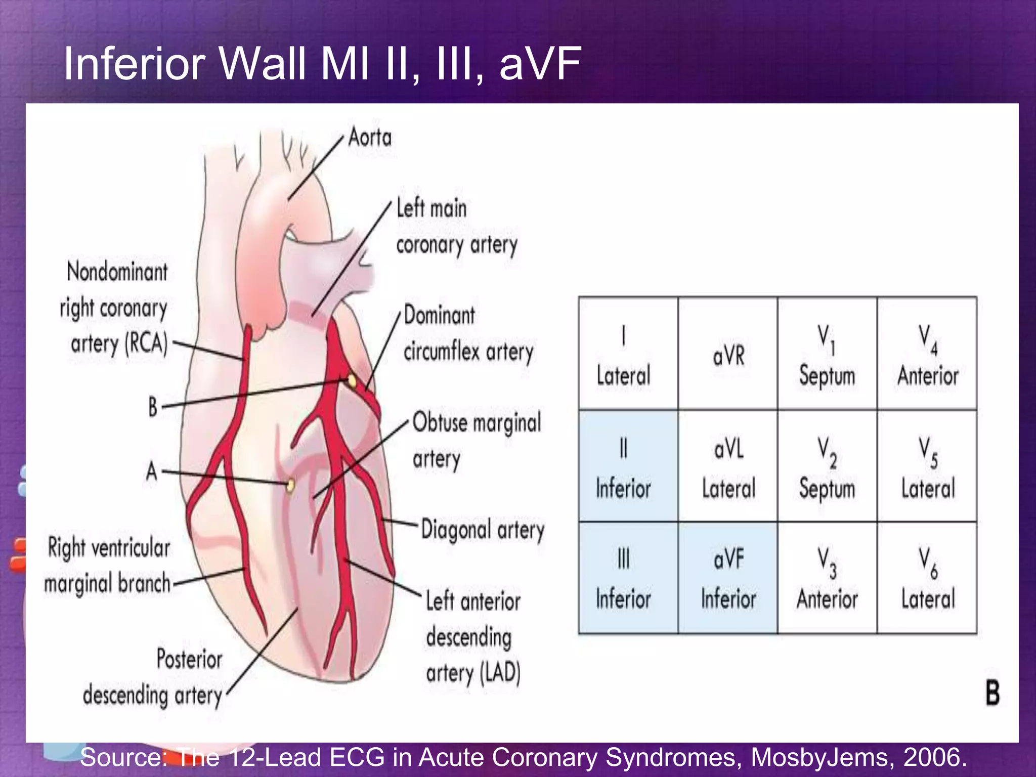 Inferior Wall MI II, III, aVF

Source: The 12-Lead ECG in Acute Coronary Syndromes, MosbyJems, 2006.

 