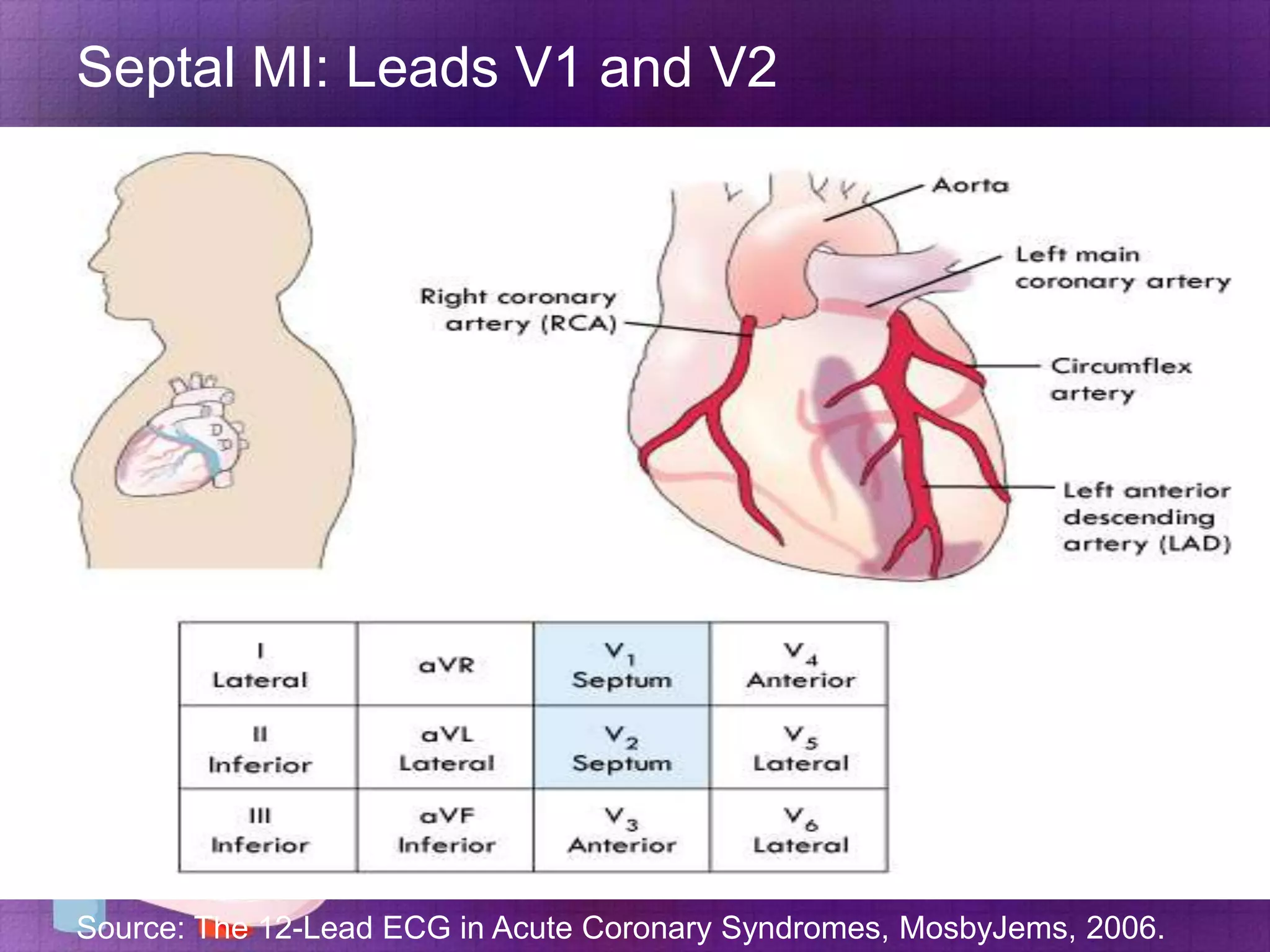 Septal MI: Leads V1 and V2

Source: The 12-Lead ECG in Acute Coronary Syndromes, MosbyJems, 2006.

 