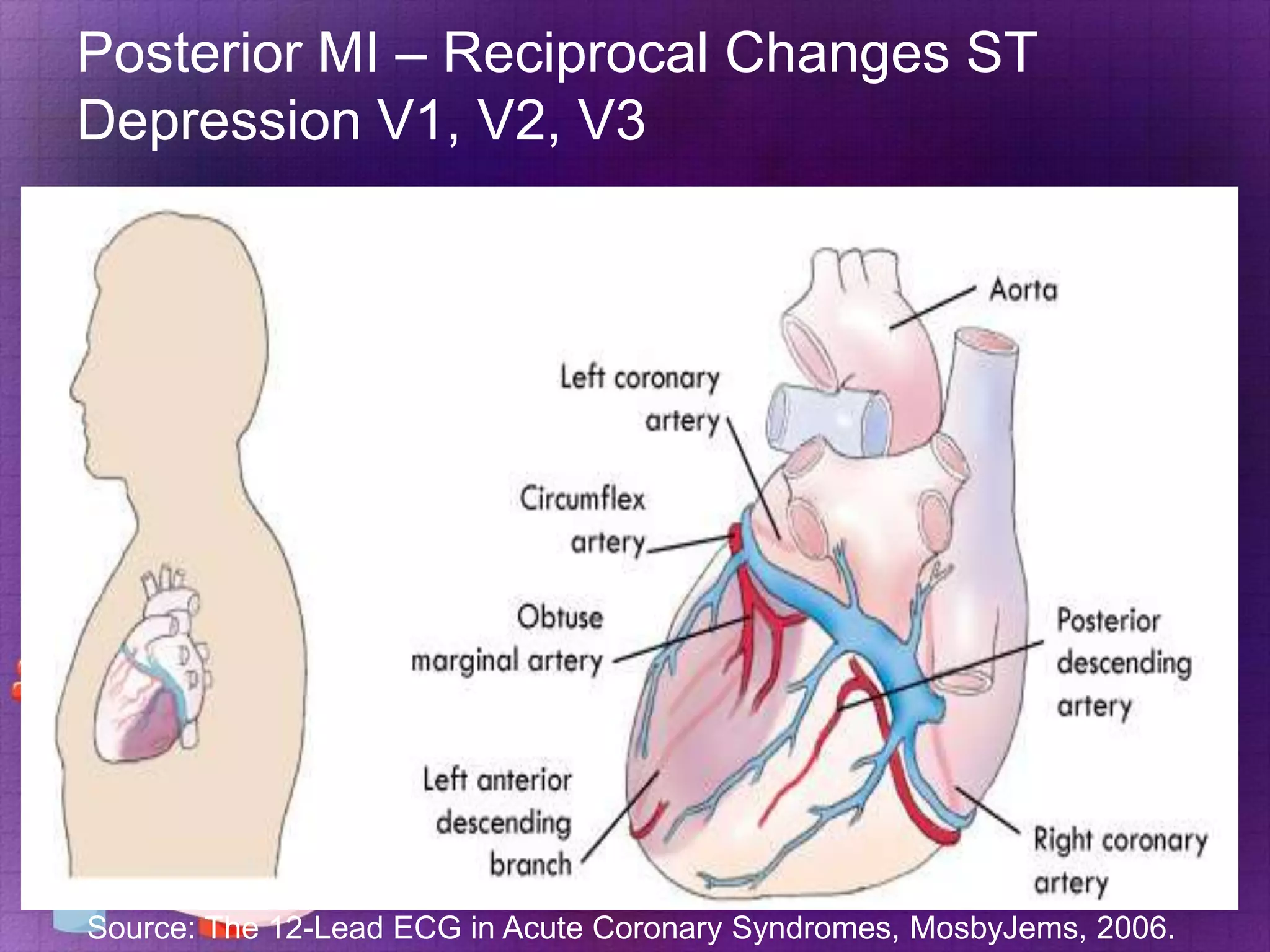 Posterior MI – Reciprocal Changes ST
Depression V1, V2, V3

Source: The 12-Lead ECG in Acute Coronary Syndromes, MosbyJems, 2006.

 
