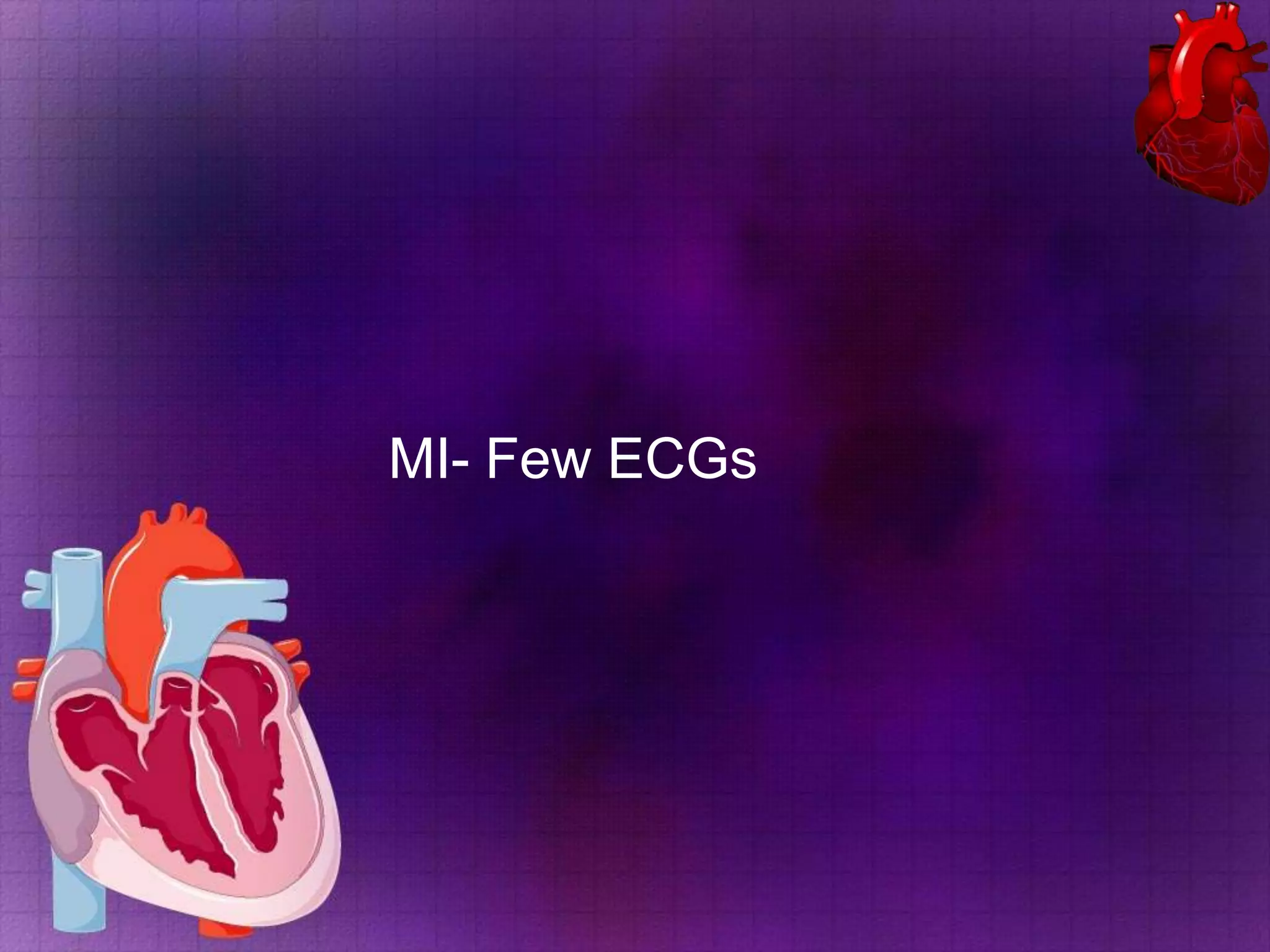 MI- Few ECGs

 