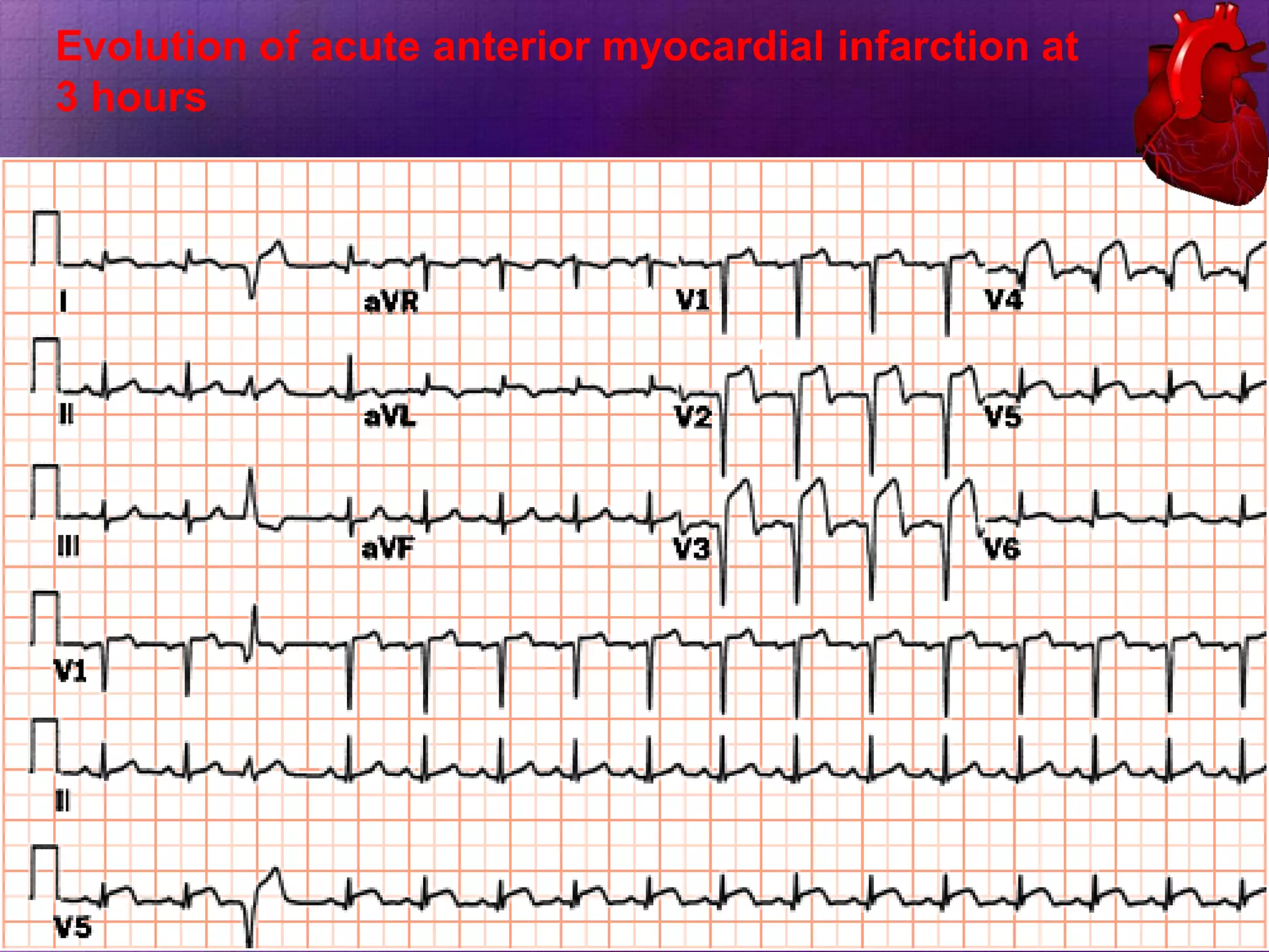 Evolution of acute anterior myocardial infarction at
3 hours

 
