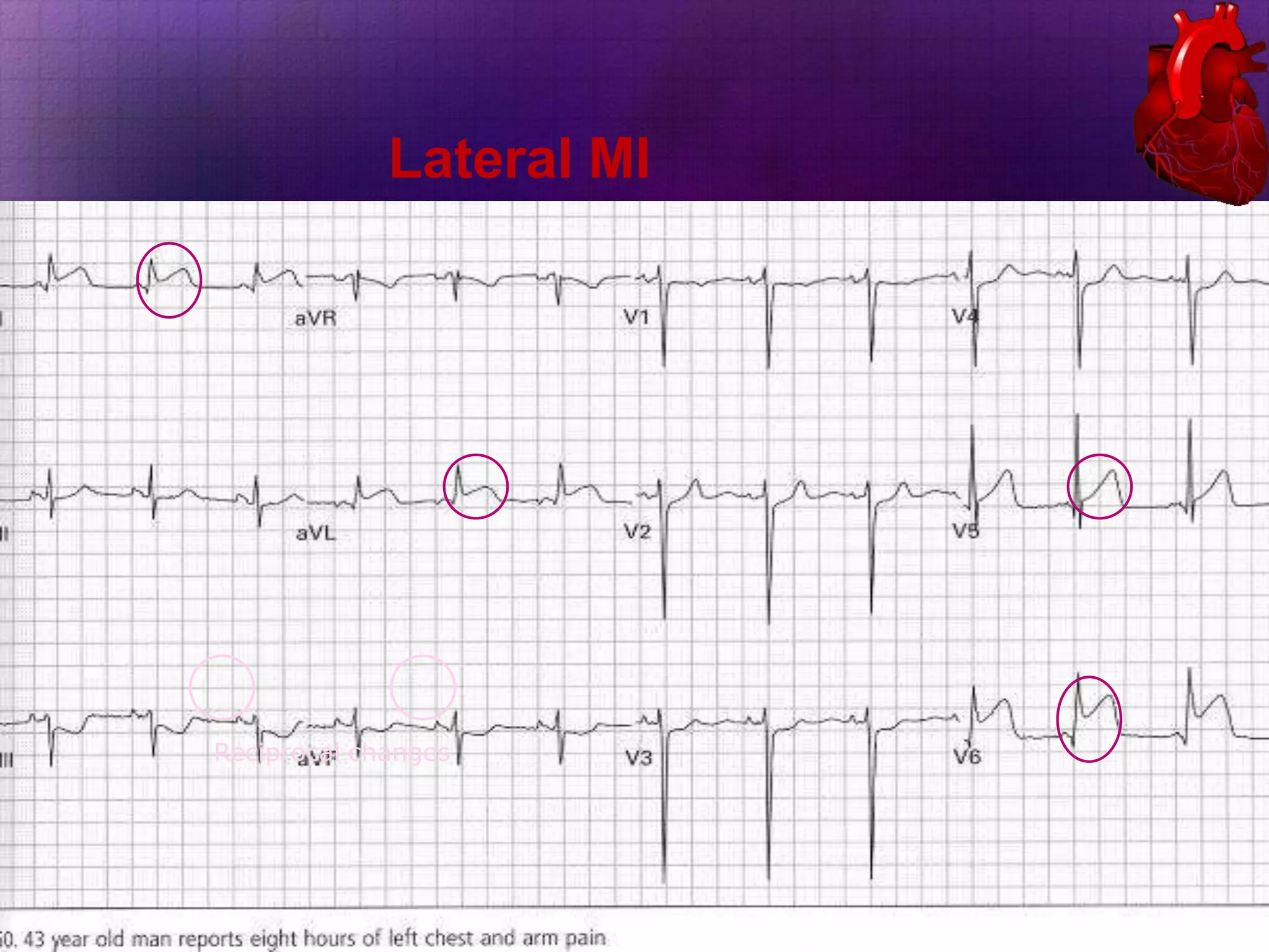 Lateral MI

Reciprocal changes

 