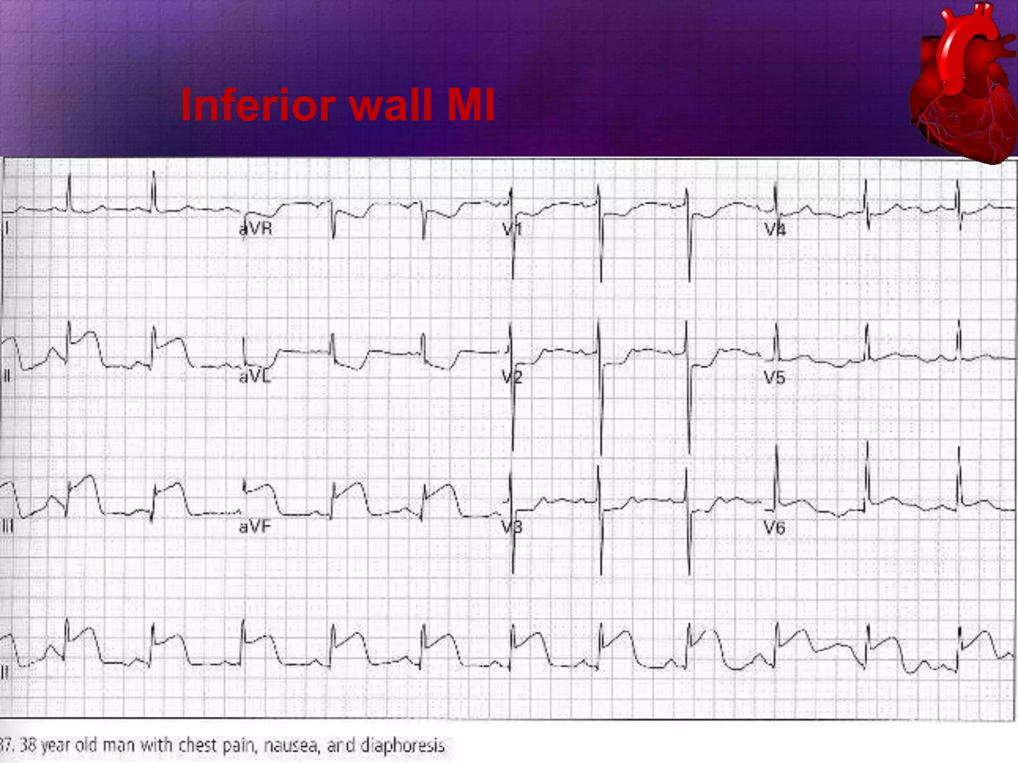 Inferior wall MI

 