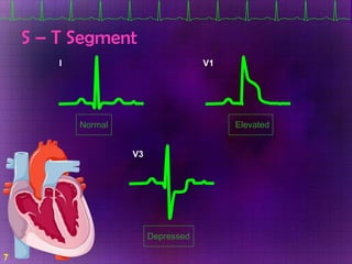 Acute coronary syndrome
• Based on ECG and cardiac enzymes, ACS is classified
into:
– STEMI: ST elevation, elevated cardia...