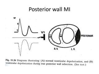 Posterior wall MI
 