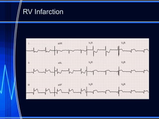 Preload Effected Rv Infarct electrocardiography in acute coronary syndrome.pptx