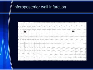 Inferoposterior Infarction electrocardiography in acute coronary syndrome.pptx