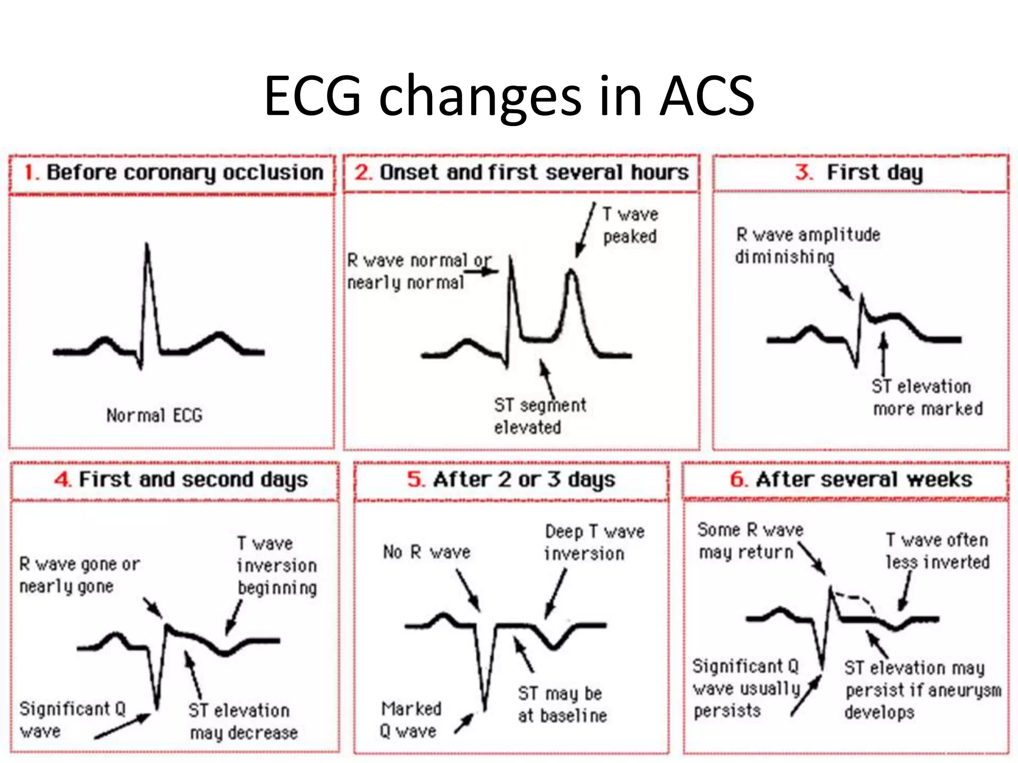 Ecg in acute coronary syndrome and acute care PPT Heart and