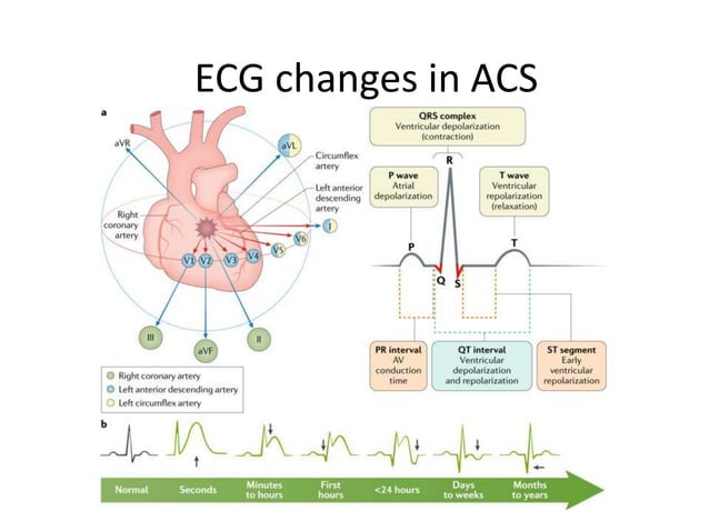 Ecg in acute coronary syndrome and acute care | PPT | Heart and ...