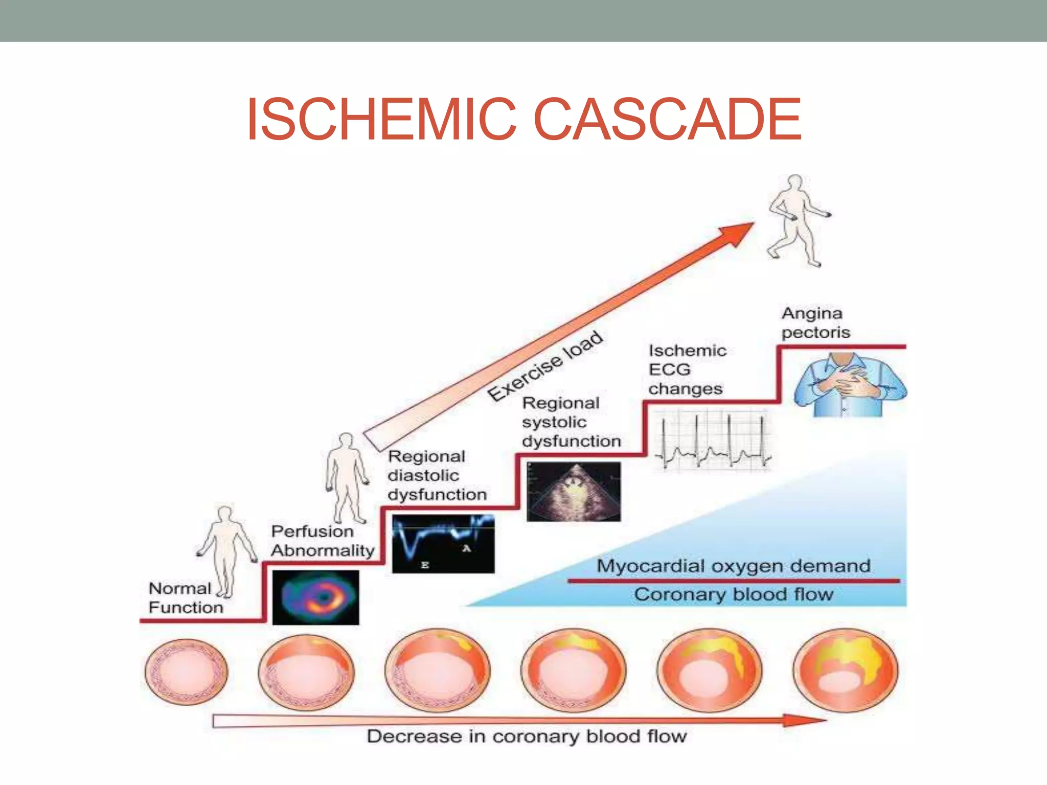 ECG in Acute Myocardial Infarction | PPTX