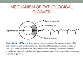 Path Q Wave ECG in Acute Myocardial Infarction | PPTX